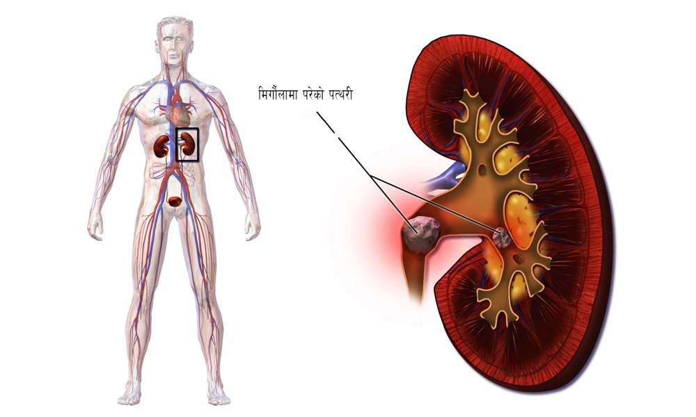 मिर्गौलाको रोगबारे जानी राखौं १२ कुरा