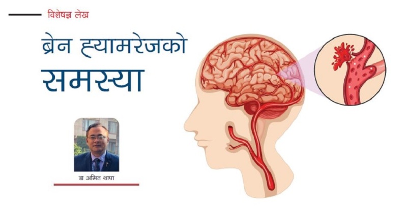 किन बढ्छ ब्रेन ह्यामरेजको समस्या ?