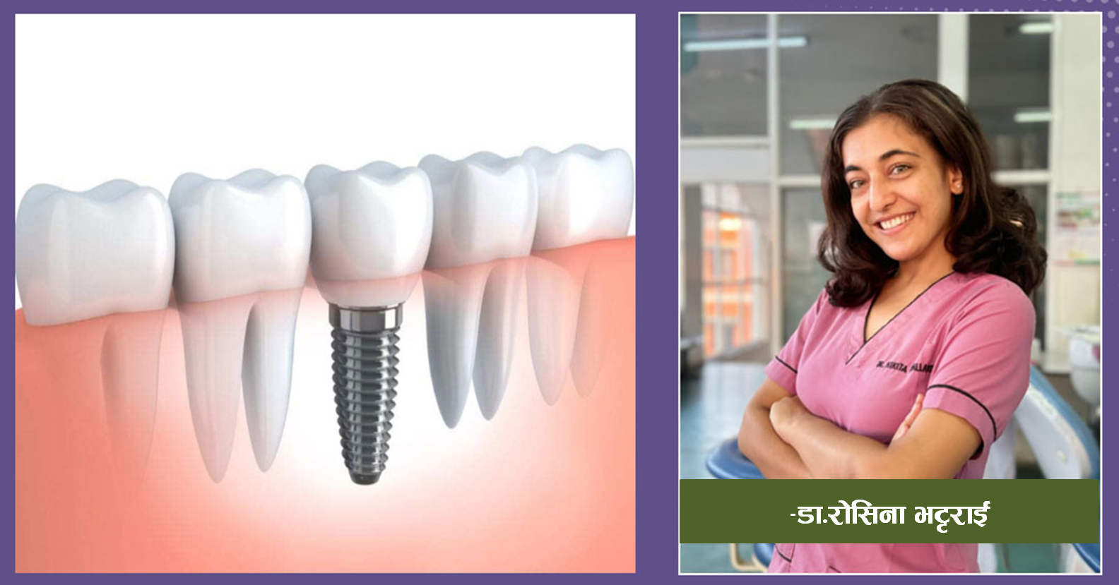 के हो डेन्टल इम्प्लान्ट भनेको, किन गरिन्छ ?